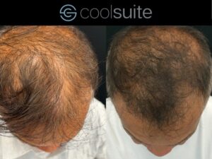 Hair Restoration